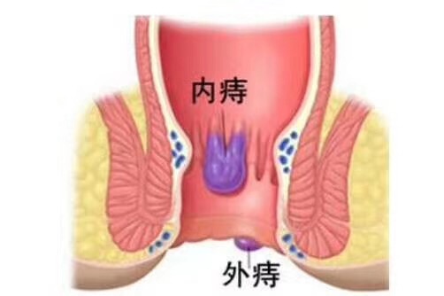 無創(chuàng)痔瘡治療儀(圖1)